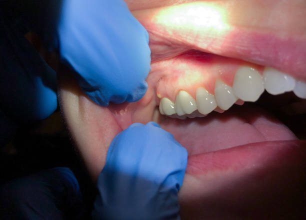 Best Emergency Wisdom Teeth Removal in Saratoga Springs, UT